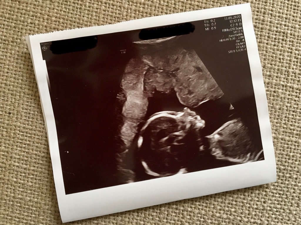 Ultraschallbild eines Babys im Mutterleib.
